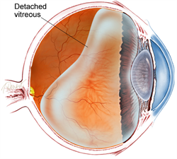 Diagram of vitreous gel separating from the retina