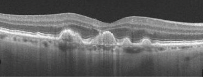 Dry AMD on an OCT scan