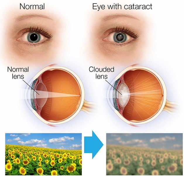 Illustration of a clear natural lens and a cloudy lens with cataract