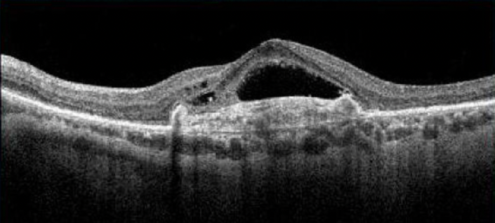 Wet AMD on an OCT scan