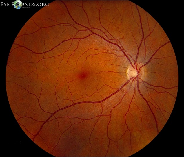 Normal retina