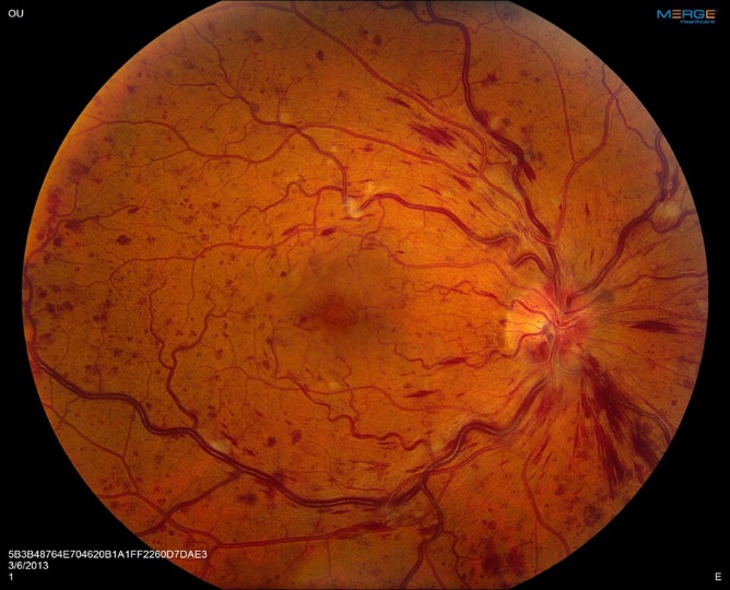 Retina with a central retinal vein occlusion