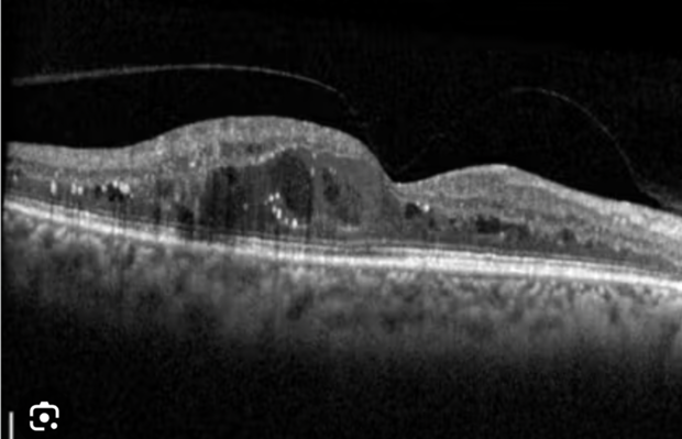 Diabetic macular oedema on an OCT scan