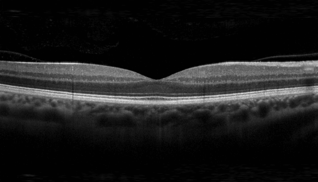 Normal macula on an OCT scan