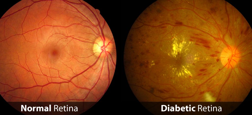 Comparison of a normal retina and a retina affected by diabetes