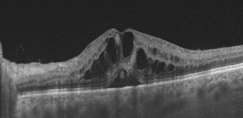 Cystoid macular oedema on an OCT scan