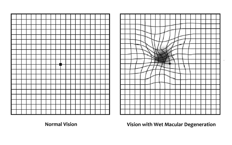Illustration comparing a normal Amsler grid with how distortion may appear